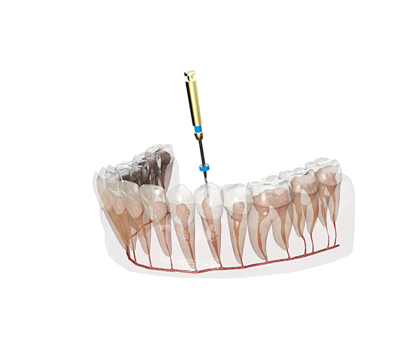 重度の虫歯には「根管治療」