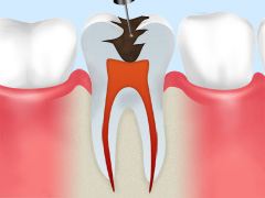 虫歯菌に汚染された部分を削ります。