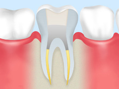 症例によって、歯根に土台を入れます。