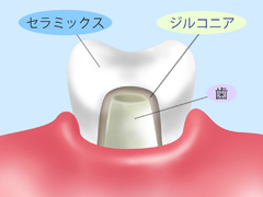 フルジルコニア