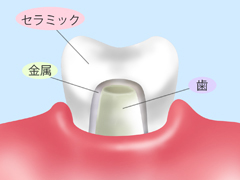 メタルセラミック