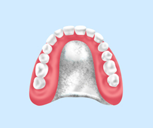 チタン床義歯