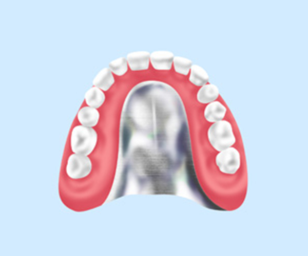 コバルトクロム床義歯