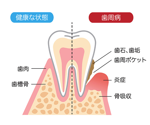 歯周病は身近な病気です