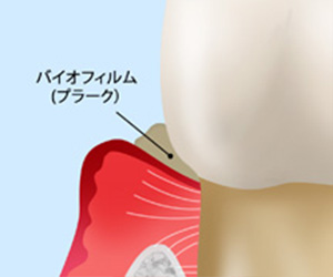 軽度の歯周病（歯周炎）