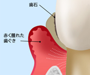 中等度の歯周病（歯周炎）